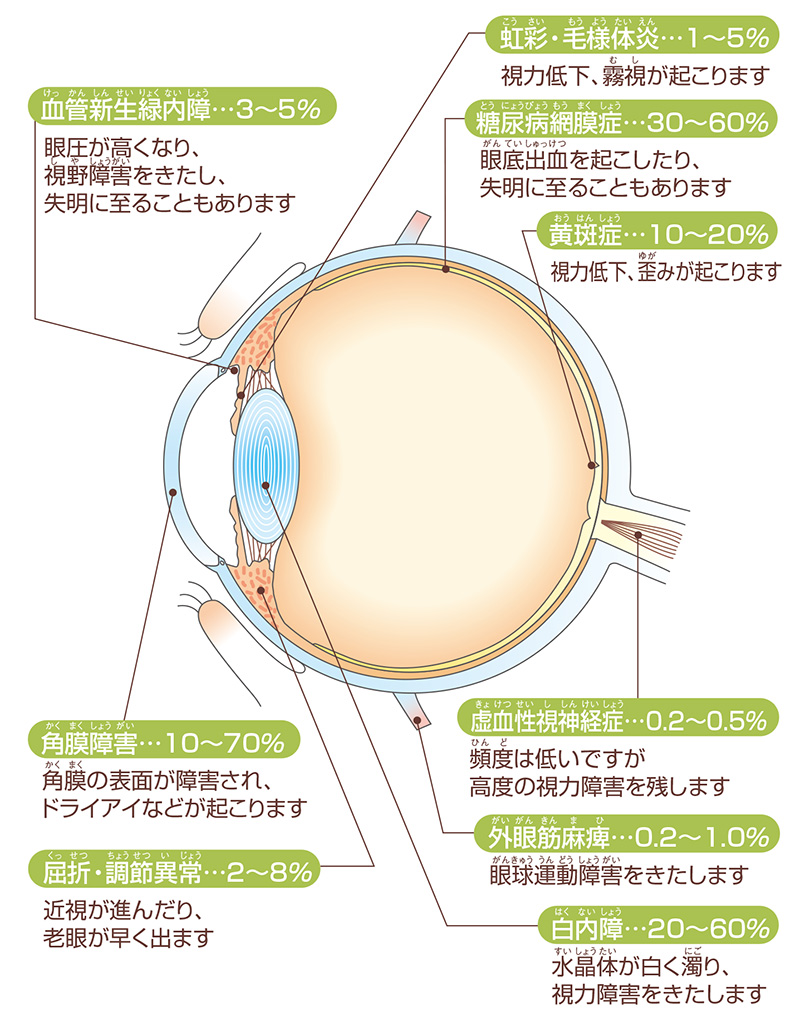 画像：糖尿病の眼の合併症が起こる割合