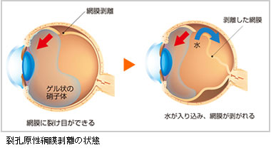 牽引性網膜剥離の合併症